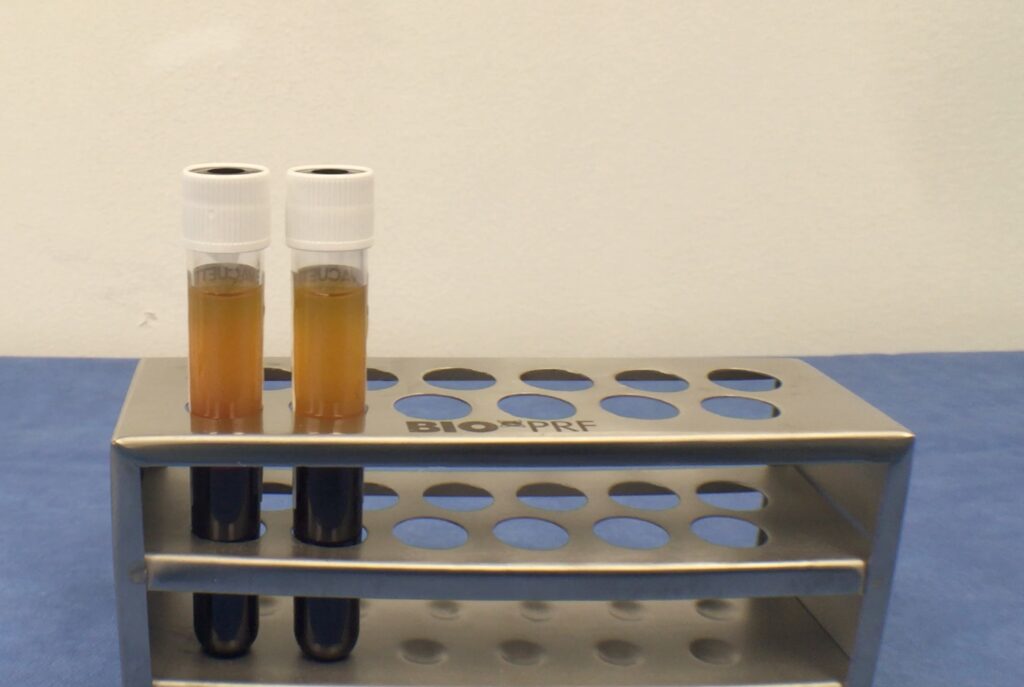 Fig.2 Blood derived Platelet-Rich Fibrin derived from patient blood.