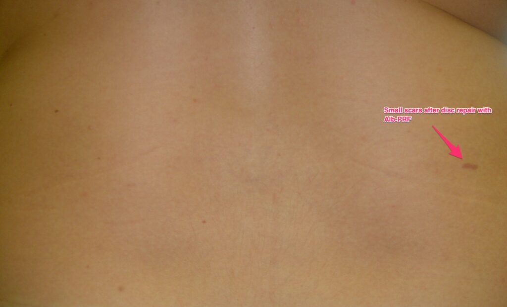 Fig.3 Annular tear can be treated via small injection – see arrow. No surgery needed, no hospitalization or lengthy recovery needed.